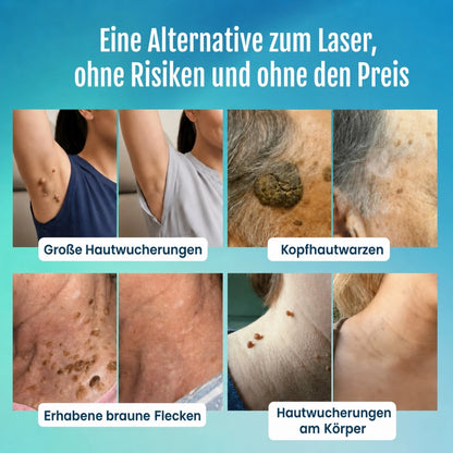 Fortschrittlicher Anti-Makel-Stift